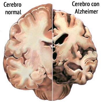 Alzheimer, principales causas y factores de riesgo